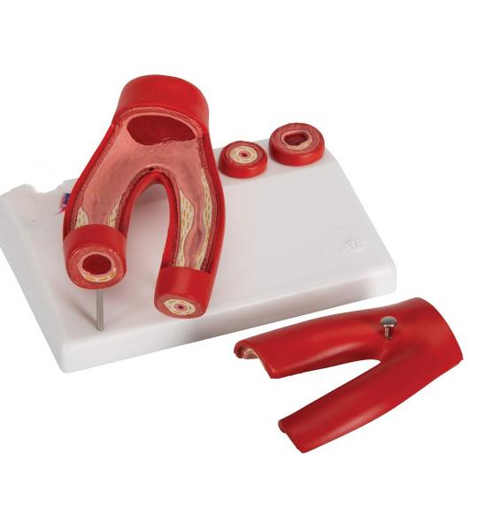 Arteriosclerosis Model, with cross section of artery, 2 part | Anatomy Premium Quality Model