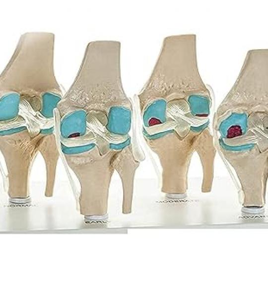 Knee 4 Stage Arthritis Model