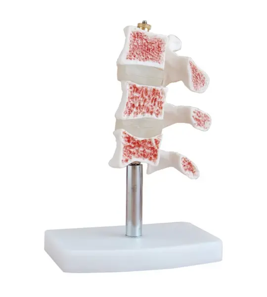 Cutaway Osteoporosis Anatomical Model