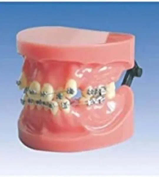 Fixed Orthodontic Model – Dislocation Type