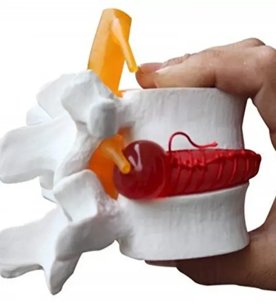 Lumbar Spine Herniated Disc Prolapse Demonstration Model